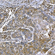 IHC staining of FFPE human larynx squamous cell carcinoma tissue with Semaphorin-4F antibody. HIER: boil tissue sections in pH8 EDTA for 20 min and allow to cool before testing.