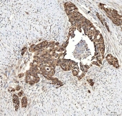 IHC staining of FFPE human ovarian serous adenocarcinoma tissue with FAM60A antibody. HIER: boil tissue sections in pH8 EDTA for 20 min and allow to cool before testing.