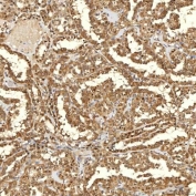 IHC staining of FFPE human thyroid cancer tissue with FAM60A antibody. HIER: boil tissue sections in pH8 EDTA for 20 min and allow to cool before testing.