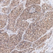 IHC staining of FFPE human liver cancer tissue with FAM60A antibody. HIER: boil tissue sections in pH8 EDTA for 20 min and allow to cool before testing.