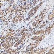 IHC staining of FFPE human prostate adenocarcinoma tissue with FAM60A antibody. HIER: boil tissue sections in pH8 EDTA for 20 min and allow to cool before testing.