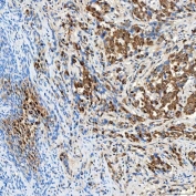 IHC staining of FFPE human lung adenocarcinoma tissue with FAM60A antibody. HIER: boil tissue sections in pH8 EDTA for 20 min and allow to cool before testing.