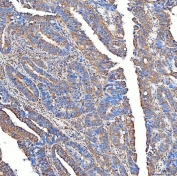 IHC staining of FFPE human rectum adenocarcinoma tissue with Ferroportin 1 antibody. HIER: boil tissue sections in pH8 EDTA for 20 min and allow to cool before testing.