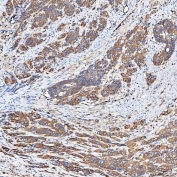 IHC staining of FFPE human prostate adenocarcinoma tissue with Ferroportin 1 antibody. HIER: boil tissue sections in pH8 EDTA for 20 min and allow to cool before testing.