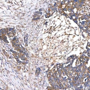 IHC staining of FFPE human ovarian serous adenocarcinoma tissue with Ferroportin 1 antibody. HIER: boil tissue sections in pH8 EDTA for 20 min and allow to cool before testing.