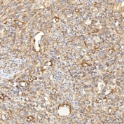 IHC staining of FFPE human larynx squamous cell carcinoma tissue with Ferroportin 1 antibody. HIER: boil tissue sections in pH8 EDTA for 20 min and allow to cool before testing.