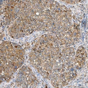 IHC staining of FFPE human liver cancer tissue with Ferroportin 1 antibody. HIER: boil tissue sections in pH8 EDTA for 20 min and allow to cool before testing.