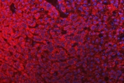 Immunofluorescent staining of FFPE human liver cancer tissue with SLC25A10 antibody (red) and DAPI nuclear stain (blue). HIER: steam section in pH6 citrate buffer for 20 min.