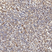 IHC staining of FFPE human diffuse large B cell lymphoma tissue with SLC25A10 antibody. HIER: boil tissue sections in pH8 EDTA for 20 min and allow to cool before testing.