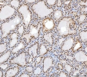 IHC staining of FFPE human thyroid cancer tissue with Transcription factor SP1 antibody. HIER: boil tissue sections in pH8 EDTA for 20 min and allow to cool before testing.