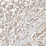 IHC staining of FFPE human breast cancer tissue with TXNDC5 antibody. HIER: boil tissue sections in pH8 EDTA for 20 min and allow to cool before testing.
