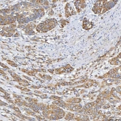 IHC staining of FFPE human prostate adenocarcinoma tissue with TXNDC5 antibody. HIER: boil tissue sections in pH8 EDTA for 20 min and allow to cool before testing.