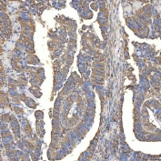 IHC staining of FFPE human rectum adenocarcinoma tissue with TXNDC5 antibody. HIER: boil tissue sections in pH8 EDTA for 20 min and allow to cool before testing.