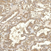 IHC staining of FFPE human thyroid papillary carcinoma tissue with TXNDC5 antibody. HIER: boil tissue sections in pH8 EDTA for 20 min and allow to cool before testing.