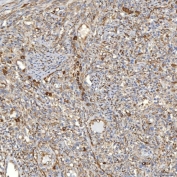 IHC staining of FFPE human larynx squamous cell carcinoma tissue with TXNDC5 antibody. HIER: boil tissue sections in pH8 EDTA for 20 min and allow to cool before testing.