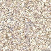 IHC staining of FFPE human renal cancer tissue with TXNDC5 antibody. HIER: boil tissue sections in pH8 EDTA for 20 min and allow to cool before testing.