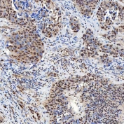 IHC staining of FFPE human urothelial carcinoma tissue with SNF2H antibody. HIER: boil tissue sections in pH8 EDTA for 20 min and allow to cool before testing.