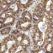 IHC staining of FFPE human endometrioid adenocarcinoma tissue with SNF2H antibody. HIER: boil tissue sections in pH8 EDTA for 20 min and allow to cool before testing.