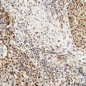 IHC staining of FFPE human esophageal squamous carcinoma tissue with SNF2H antibody. HIER: boil tissue sections in pH8 EDTA for 20 min and allow to cool before testing.