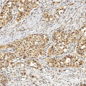IHC staining of FFPE human appendix adenocarcinoma tissue with SNF2H antibody. HIER: boil tissue sections in pH8 EDTA for 20 min and allow to cool before testing.