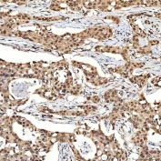 IHC staining of FFPE human breast cancer tissue with SNF2H antibody. HIER: boil tissue sections in pH8 EDTA for 20 min and allow to cool before testing.