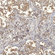 IHC staining of FFPE human lung adenocarcinoma tissue with SNF2H antibody. HIER: boil tissue sections in pH8 EDTA for 20 min and allow to cool before testing.