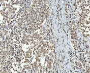 IHC staining of FFPE human breast cancer tissue with SMC6 antibody. HIER: boil tissue sections in pH8 EDTA for 20 min and allow to cool before testing.
