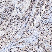 IHC staining of FFPE human urothelial carcinoma tissue with SNRNP40 antibody. HIER: boil tissue sections in pH8 EDTA for 20 min and allow to cool before testing.