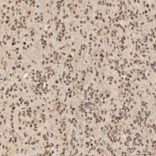 IHC staining of FFPE human glioblastoma tissue with SNRNP40 antibody. HIER: boil tissue sections in pH8 EDTA for 20 min and allow to cool before testing.