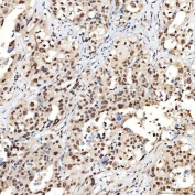 IHC staining of FFPE human appendix adenocarcinoma tissue with SNRNP40 antibody. HIER: boil tissue sections in pH8 EDTA for 20 min and allow to cool before testing.