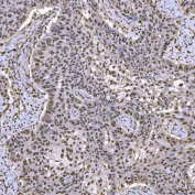 IHC staining of FFPE human larynx squamous cell carcinoma tissue with U2 snRNP A antibody. HIER: boil tissue sections in pH8 EDTA for 20 min and allow to cool before testing.