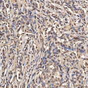 IHC staining of FFPE human lung adenocarcinoma tissue with U2 snRNP A antibody. HIER: boil tissue sections in pH8 EDTA for 20 min and allow to cool before testing.