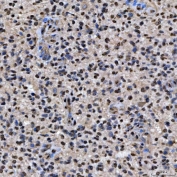 IHC staining of FFPE human glioblastoma tissue with U2 snRNP A antibody. HIER: boil tissue sections in pH8 EDTA for 20 min and allow to cool before testing.