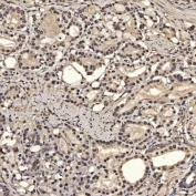 IHC staining of FFPE human prostate adenocarcinoma tissue with U2 snRNP A antibody. HIER: boil tissue sections in pH8 EDTA for 20 min and allow to cool before testing.