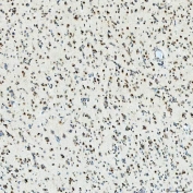 IHC staining of FFPE human glioblastoma tissue with U1 snRNP C antibody. HIER: boil tissue sections in pH8 EDTA for 20 min and allow to cool before testing.