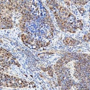 IHC staining of FFPE human urothelial carcinoma tissue with U1 snRNP C antibody. HIER: boil tissue sections in pH8 EDTA for 20 min and allow to cool before testing.