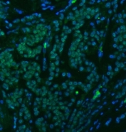 Immunofluorescent staining of FFPE human breast cancer tissue with U1 snRNP C antibody (green) and DAPI nuclear stain (blue). HIER: steam section in pH8 EDTA buffer for 20 min.