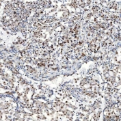 IHC staining of FFPE human lung adenocarcinoma tissue with U1 snRNP C antibody. HIER: boil tissue sections in pH8 EDTA for 20 min and allow to cool before testing.
