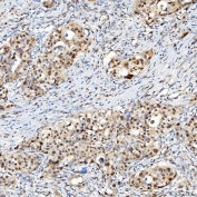 IHC staining of FFPE human appendix adenocarcinoma tissue with U1 snRNP C antibody. HIER: boil tissue sections in pH8 EDTA for 20 min and allow to cool before testing.