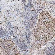 IHC staining of FFPE human esophageal squamous carcinoma tissue with U1 snRNP C antibody. HIER: boil tissue sections in pH8 EDTA for 20 min and allow to cool before testing.