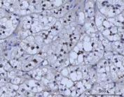 IHC staining of FFPE human adrenocortical adenoma tissue with RAD51C antibody. HIER: boil tissue sections in pH8 EDTA for 20 min and allow to cool before testing.