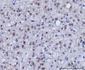 IHC staining of FFPE human liver cancer tissue with RAD51C antibody. HIER: boil tissue sections in pH8 EDTA for 20 min and allow to cool before testing.