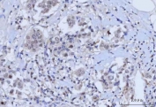 IHC staining of FFPE human breast cancer tissue with RAD51C antibody. HIER: boil tissue sections in pH8 EDTA for 20 min and allow to cool before testing.