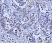 IHC staining of FFPE human larynx squamous cell carcinoma tissue with RAD51C antibody. HIER: boil tissue sections in pH8 EDTA for 20 min and allow to cool before testing.