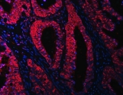 Immunofluorescent staining of FFPE human intestinal cancer with OTT3 antibody (red) and DAPI nuclear stain (blue). HIER: steam section in pH6 citrate buffer for 20 min.