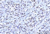 IHC staining of FFPE human breast cancer tissue with OTT3 antibody. HIER: boil tissue sections in pH8 EDTA for 20 min and allow to cool before testing.