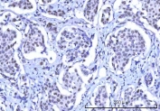 IHC staining of FFPE human esophageal squamous carcinoma tissue with OTT3 antibody. HIER: boil tissue sections in pH8 EDTA for 20 min and allow to cool before testing.