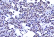 IHC staining of FFPE human ovary serous carcinoma tissue with OTT3 antibody. HIER: boil tissue sections in pH8 EDTA for 20 min and allow to cool before testing.