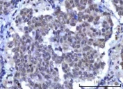 IHC staining of FFPE human lung squamous cell carcinoma tissue with OTT3 antibody. HIER: boil tissue sections in pH8 EDTA for 20 min and allow to cool before testing.