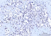 IHC staining of FFPE human gastric adenocarcinoma tissue with OTT3 antibody. HIER: boil tissue sections in pH8 EDTA for 20 min and allow to cool before testing.